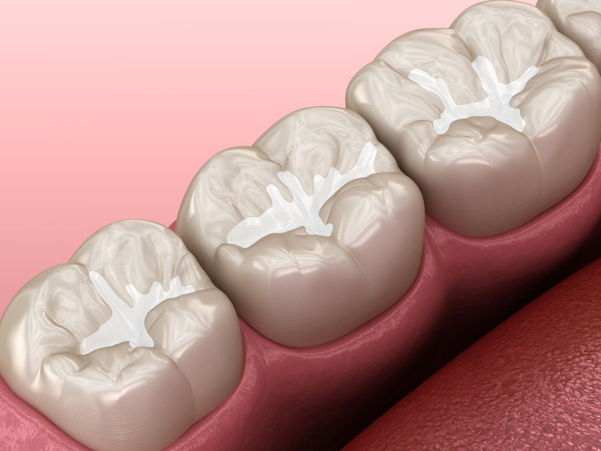 tooth-colored fillings near you
