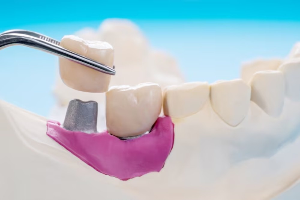 How Long Do Dental Crowns Last? Tips to Protect Your Investment